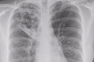 Häufig befallen Tuberkulose-Erreger die Lunge und sorgen für einen charakteristischen Röntgenbefund. Bild: iStockphoto.